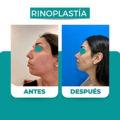 Rinoplastia - Dr. René Flores Aqueveque