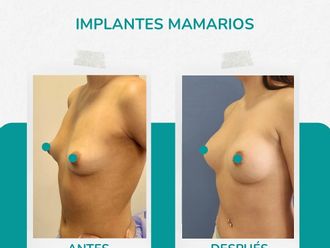 Aumento mamario antes y después - 874503