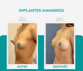 Aumento Mamario - Dr. René Flores Aqueveque