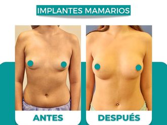 Aumento mamario antes y después - 874504