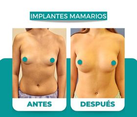 Aumento Mamario - Dr. René Flores Aqueveque