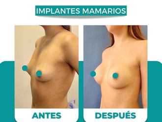 Aumento mamario antes y después - 874506