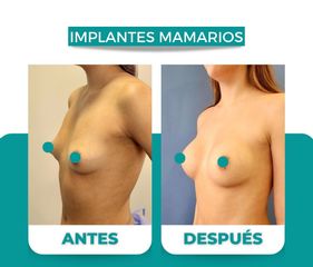 Aumento Mamario - Dr. René Flores Aqueveque