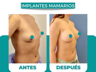Aumento mamario antes y después - 874507