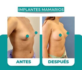 Aumento Mamario - Dr. René Flores Aqueveque