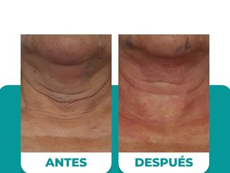 Lipopapada antes y después - 874508