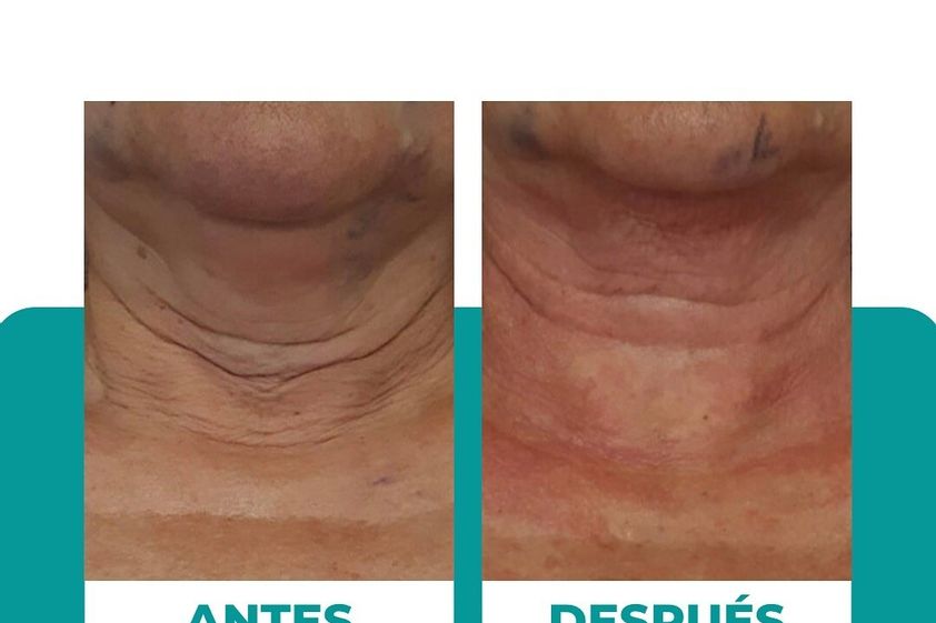 Lipopapada antes y después - 874508