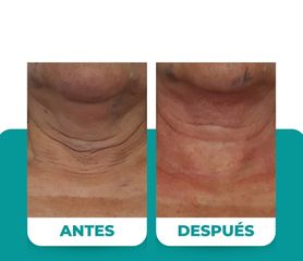 Lipopapada - Dr. René Flores Aqueveque