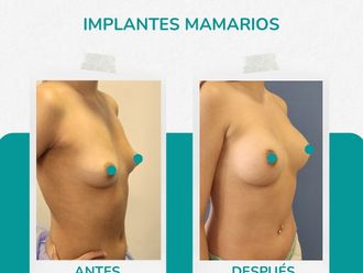 Aumento mamario antes y después - 874509