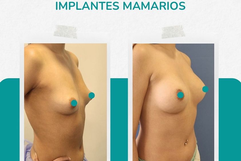 Aumento mamario antes y después - 874509