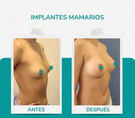 Aumento Mamario - Dr. René Flores Aqueveque