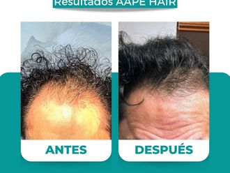 Alopecia antes y después - 874510