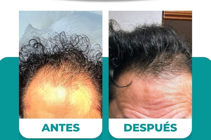 Alopecia antes y después - 874510