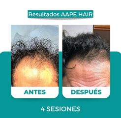 Alopecia - Dr. René Flores Aqueveque