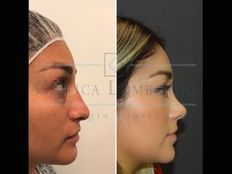 Rinoplastia - 634441