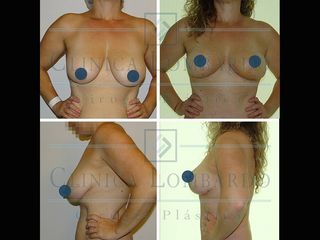 Mastopexia en T invertida. Antes y Después 3 meses de Evolución.