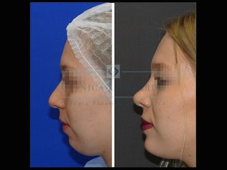 Mentoplastia antes y después - 634451