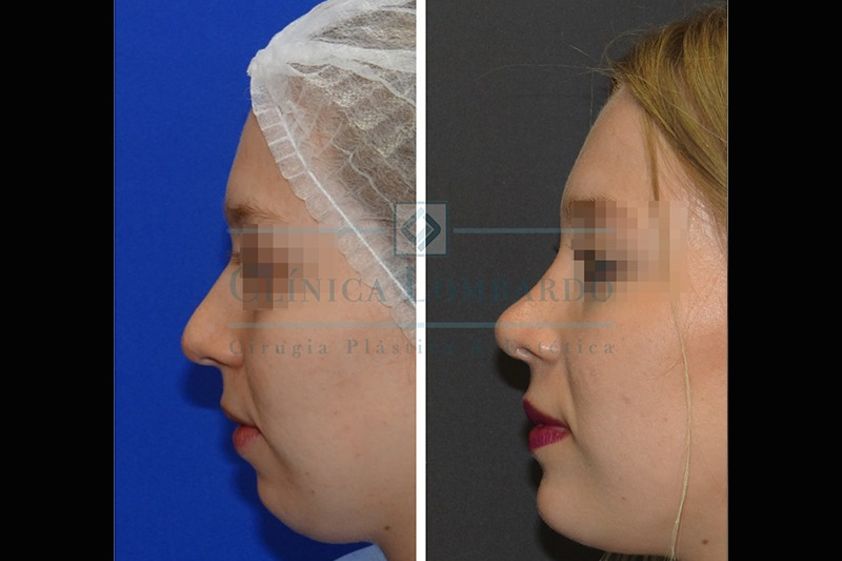 Mentoplastia antes y después - 634451