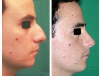 Rinoplastia - 506937