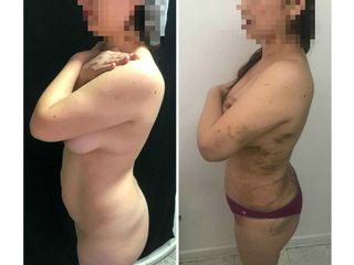 Abdominoplastia