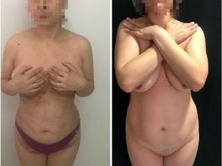Abdominoplastia
