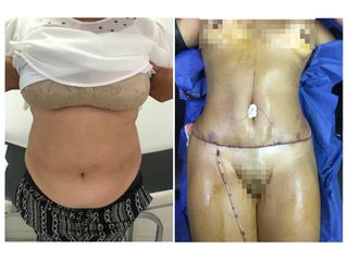 Abdominoplastia