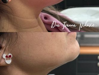 Lipopapada antes y después - 877554