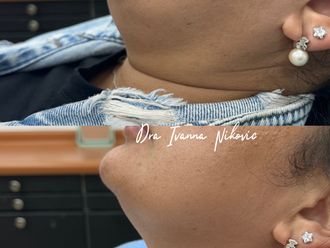 Lipopapada antes y después - 877555