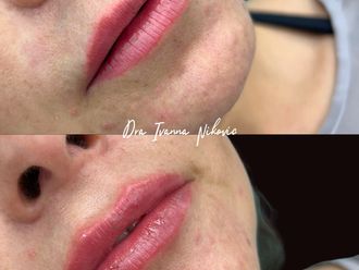 Aumento de labios antes y después - 877556