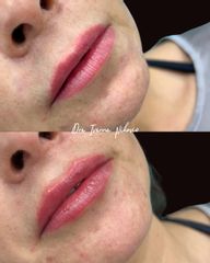 Aumento de Labios - Dra Ivanna Nikovic
