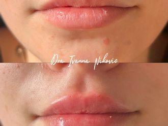 Aumento de labios antes y después - 877646