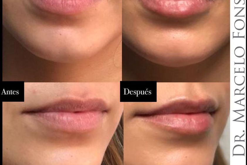 Aumento de labios antes y después - 790822