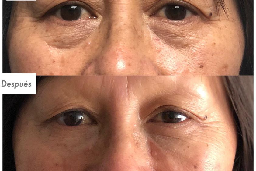 Blefaroplastía antes y después - 792946