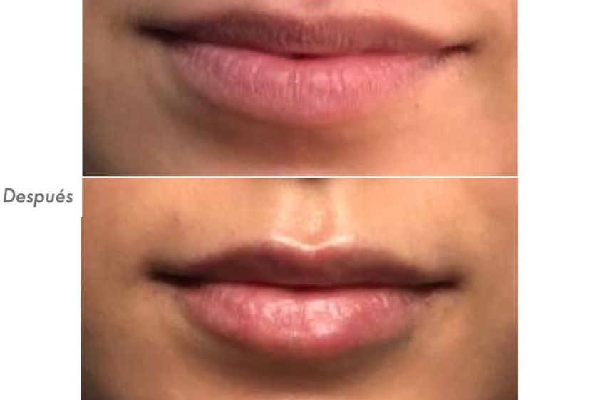 Aumento de labios antes y después - 792947