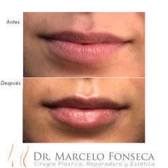Aumento de labios - Dr. Marcelo Fonseca Canteros