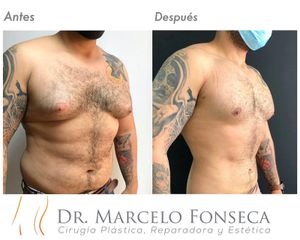 Liposucción - Dr. Marcelo Fonseca Canteros