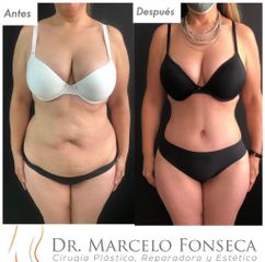 Liposucción - Dr. Marcelo Fonseca Canteros