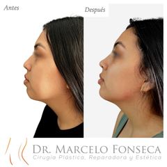 Lifting - Dr. Marcelo Fonseca Canteros