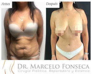 Abdominoplastia - Dr. Marcelo Fonseca Canteros