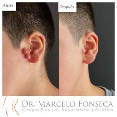Verrugas - Dr. Marcelo Fonseca Canteros