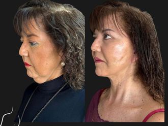 Lifting antes y después - 880763