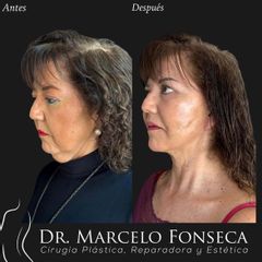 Lifting cervicofacial - Dr. Marcelo Fonseca Canteros