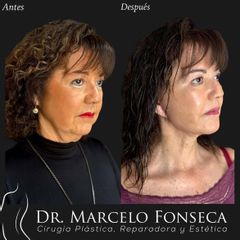 Lifting cervicofacial - Dr. Marcelo Fonseca Canteros