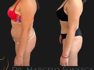 Abdominoplastía antes y después - 880765