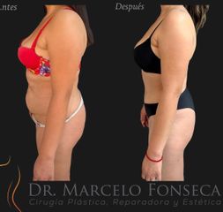 Abdominoplastía - Dr. Marcelo Fonseca Canteros