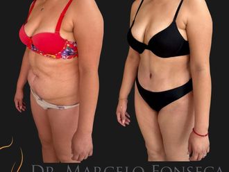 Abdominoplastía antes y después - 880766