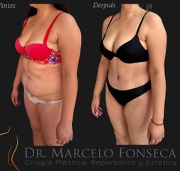 Abdominoplastía - Dr. Marcelo Fonseca Canteros