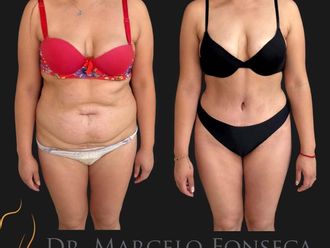 Abdominoplastía antes y después - 880767