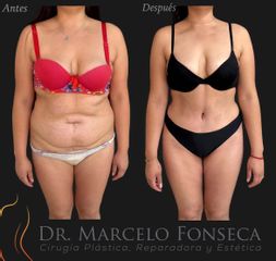 Abdominoplastía - Dr. Marcelo Fonseca Canteros