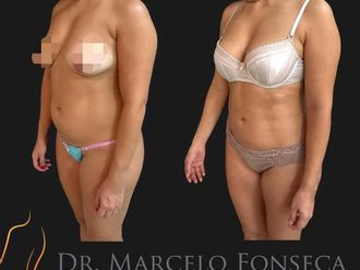 Lipoescultura antes y después - 880768